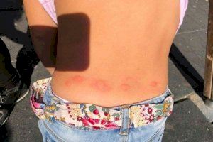 Els símptomes de picades de mosquit tigre que haurien d'alertar-te