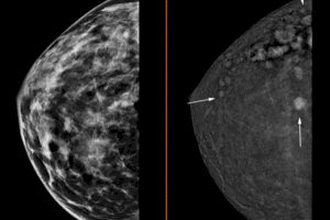 La Unidad de Mama de Ribera Salud pone en marcha la mamografía 3D con contraste que permite la detección de tumores de apenas 4 milímetros