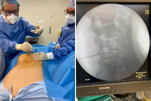 El Clínico de Valencia desarrolla una nueva técnica para descomprimir las hernias discales y aliviar el dolor