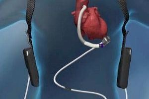 El Hospital La Fe implanta el dispositivo de asistencia cardíaca más avanzado como paso previo al trasplante