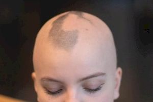 Alopecia universal: Una realidad con la que convive una mujer de Benidorm