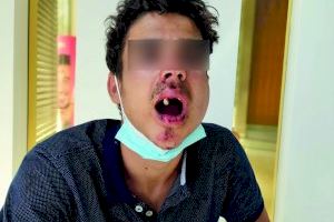 Un jove perd tres dents en una brutal pallissa a les portes d'una discoteca de Dénia