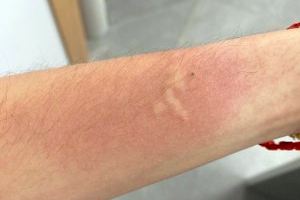 Advierten de picaduras de arañas y mosquitos al personal sanitario en un consultorio de Castellón