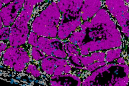 Un gen determina si las células de cáncer de mama forman metástasis o permanecen ‘dormidas’